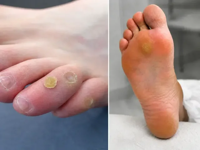 Pressure Relief for Problem Areas (Corns, Calluses) - Podiatry service