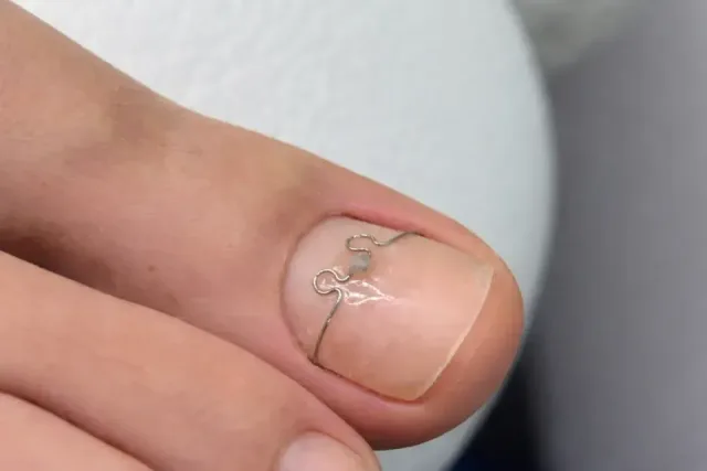 Ingrown Toenail Correction - Podiatry service