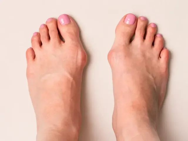 Conservative Treatment of Foot Deformities - 1